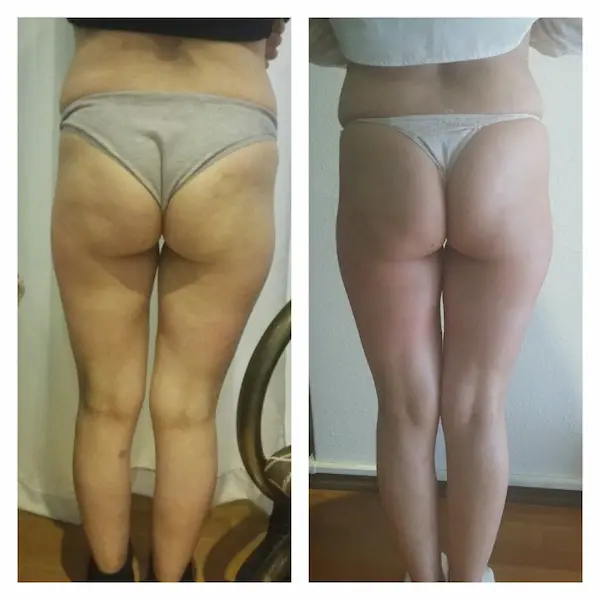 6 sesiones celulitis